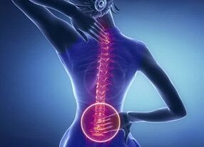 Lumbar Osteokondrosiaren adierazpenak